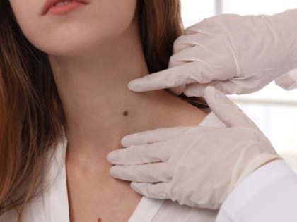 ТРАВМА РОДИНКИ И МЕЛАНОМА: ОЧЕВИДНОЙ СВЯЗИ НЕТ