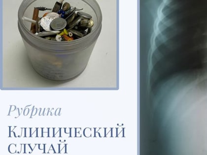 В Балакове дети проглотили монетку и колпачок от флешки. Их спасли врачи