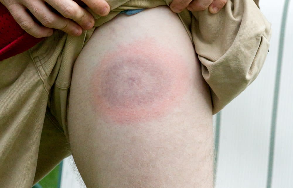 Can Lyme Disease Be Cured? Know More In Details