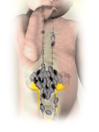 Avance en Neuroblastoma: Norgine y Eflornitina
