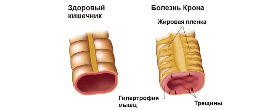 Болезнь корма. Болезнь крона кишечник. Кишечные проявления болезни крона.