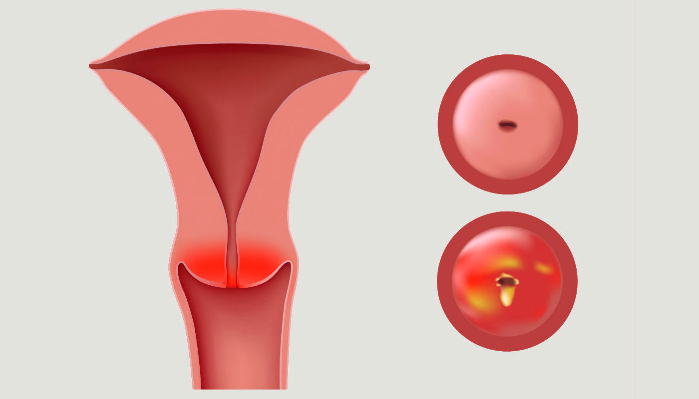 Цервицит что это у женщин причины