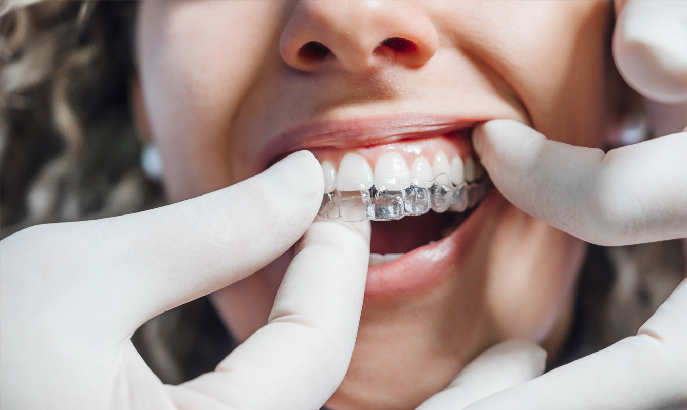 Is Invisalign Worth The Investment?
