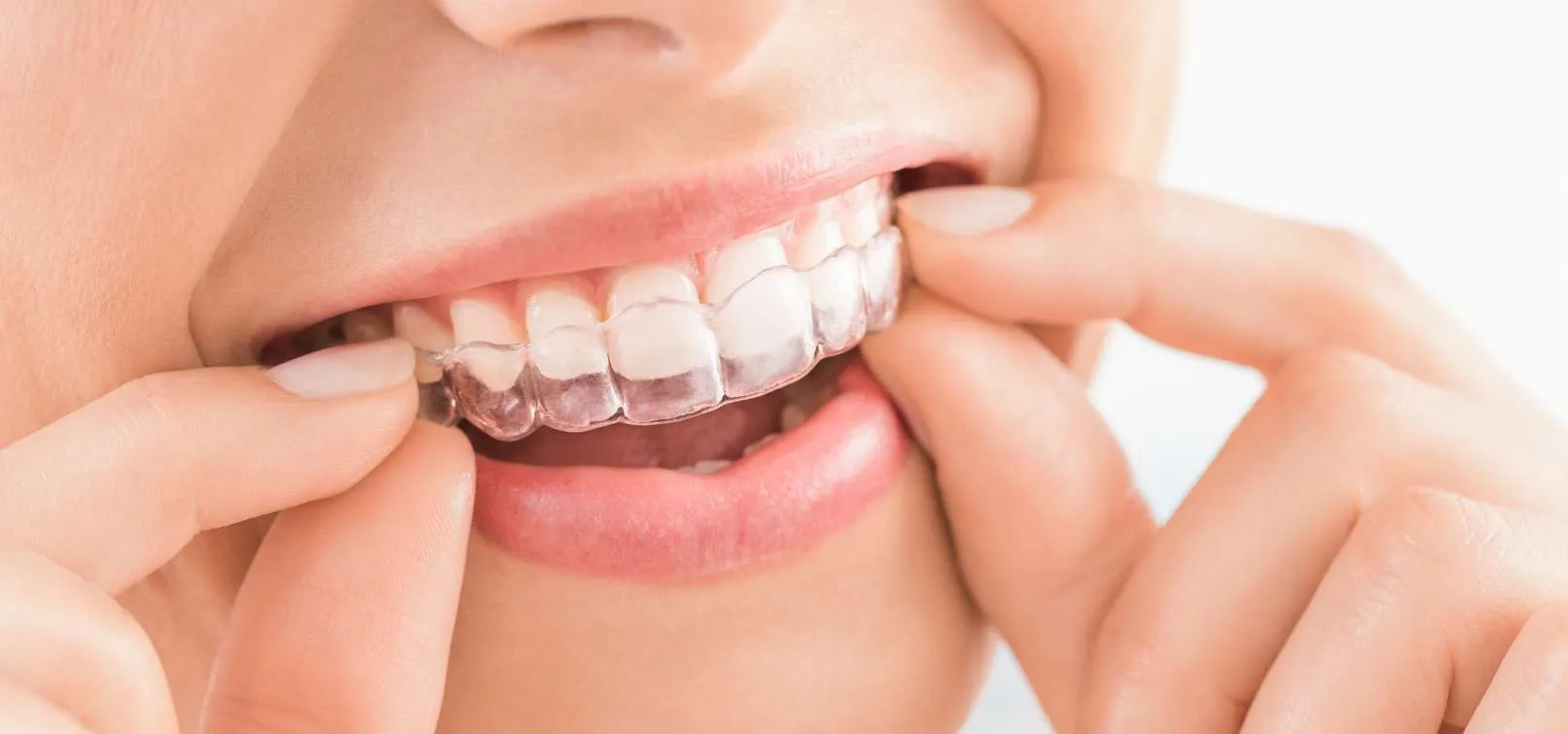How Dubai’s Invisalign Experts Are Redefining Modern Smile Makeovers