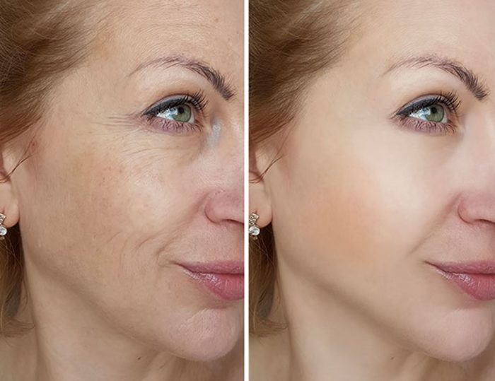 What Makes Pico Laser Better than Other Laser Treatments?