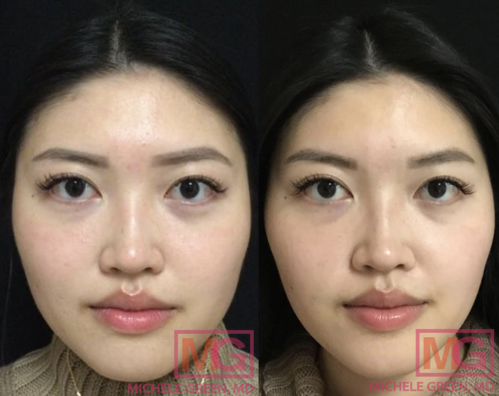 What are the Non-surgical Treatments Recommended for Jaw Reduction?