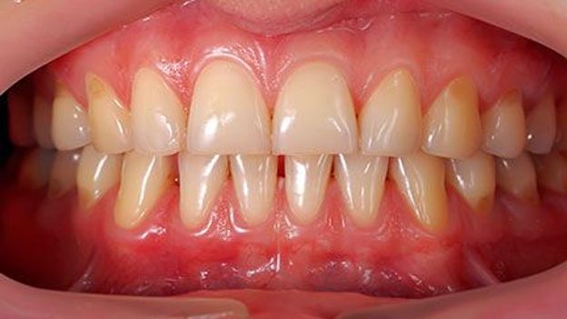 Periodontal Disease In Seniors: A Hidden Threat