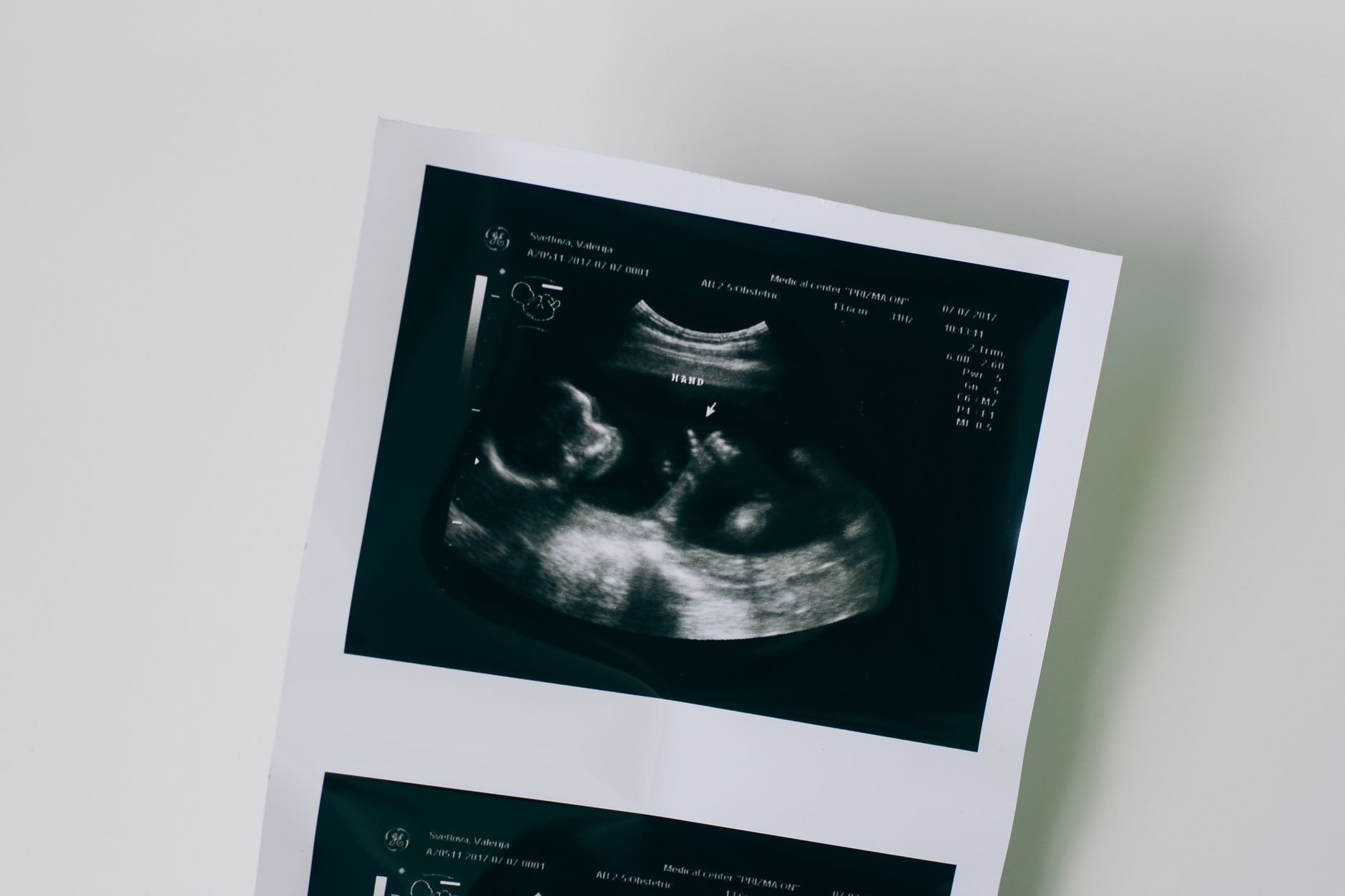 Maternal Fetal Medicine: A Subspecialty Of Obstetrics And Gynecology
