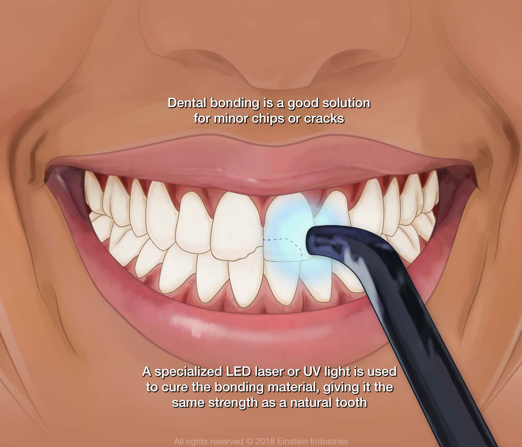 Understanding The Process Of Dental Bonding
