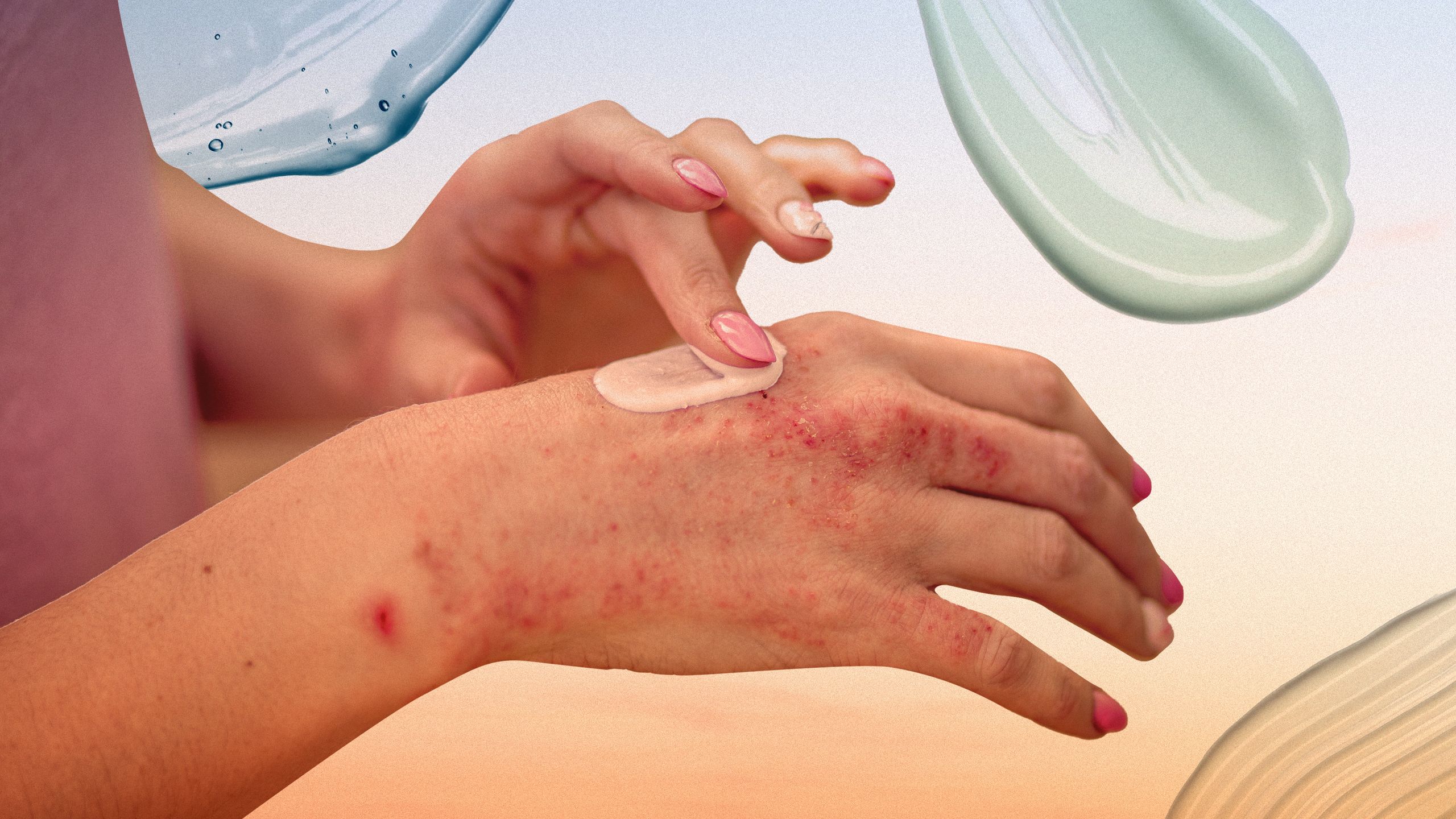 Understanding Psoriasis: A Comprehensive Guide From A Dermatologist