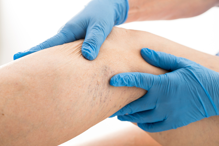 Vascular Disease Prevention and Management