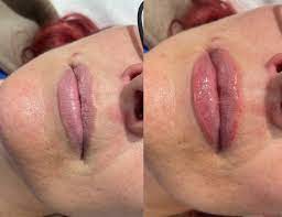 Lip Enhancement 101: Complete Guide