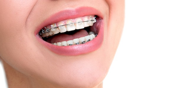 Taking Care of your Braces