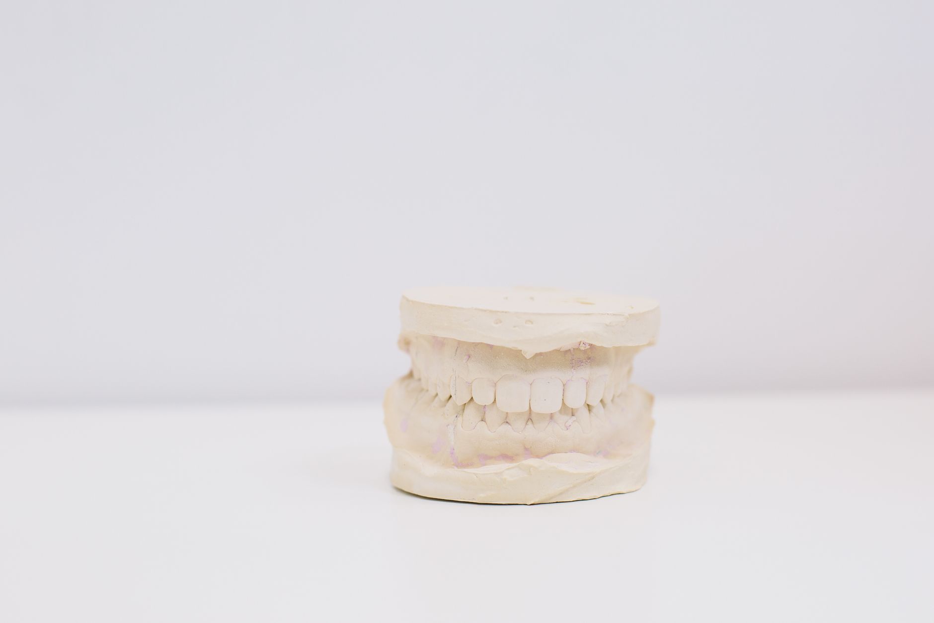 Onlay Restorations: Enhancing Strength and Longevity of Your Teeth