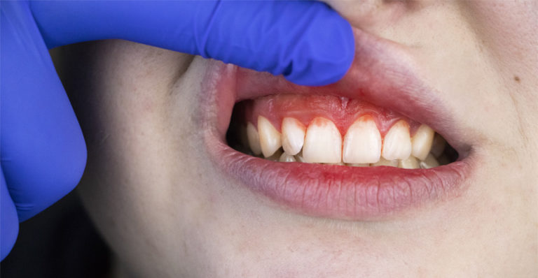 Why You Need to Worry About Gum Recession! Insights From an Expert Periodontist in Pleasantville?