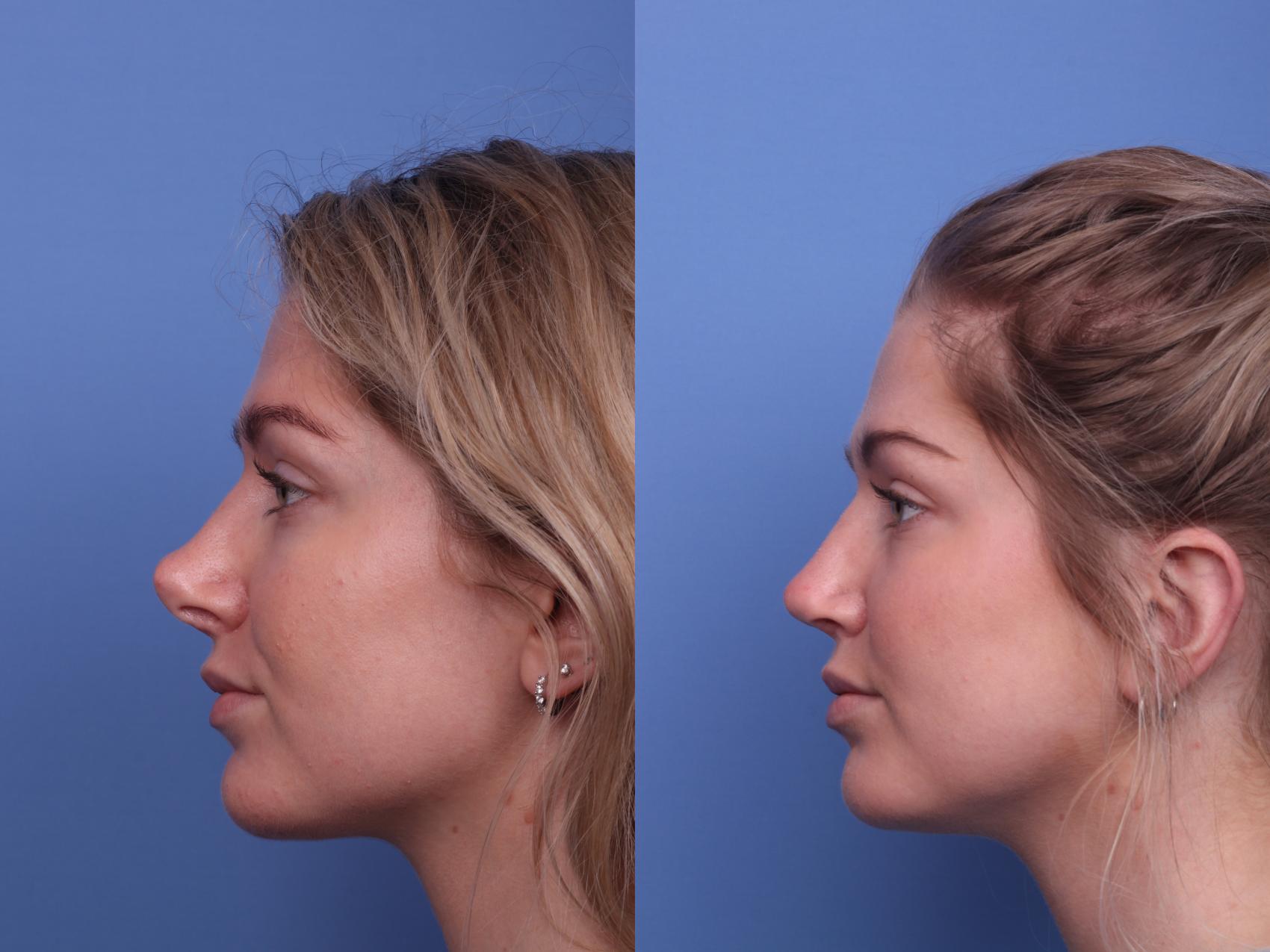 In Depth: The Process Of Rhinoplasty