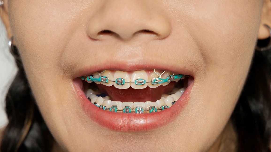 How To Maintain Good Oral Hygiene With Braces