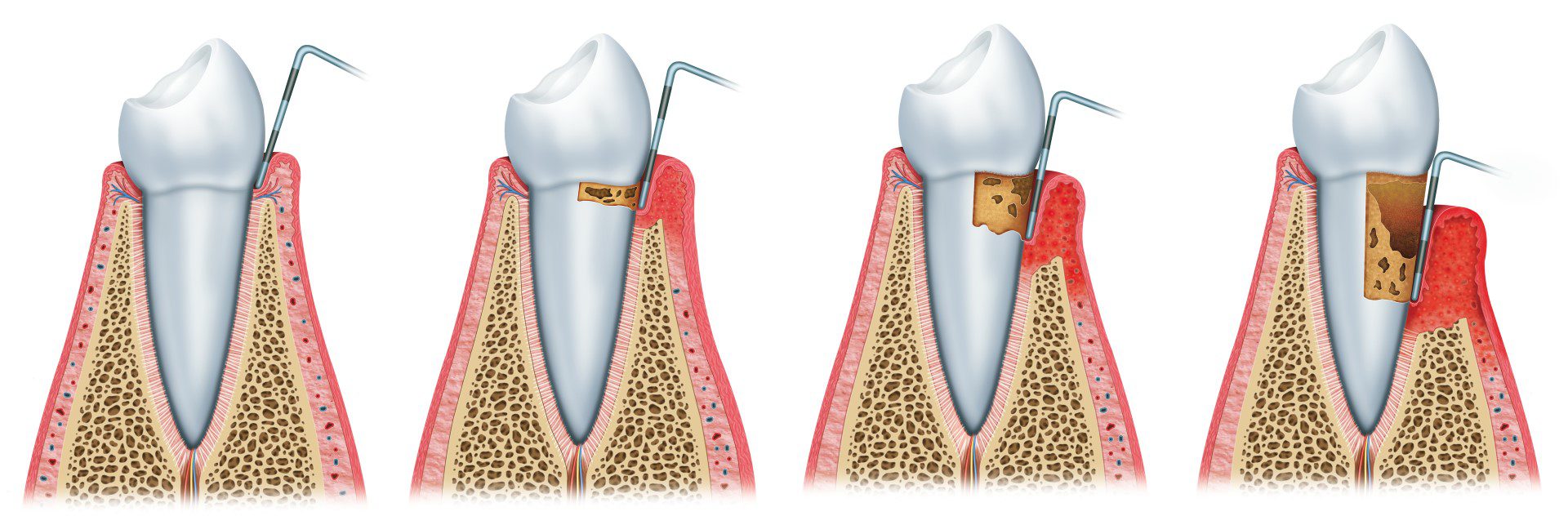 Tips for Maintaining Good Periodontal Health at Home