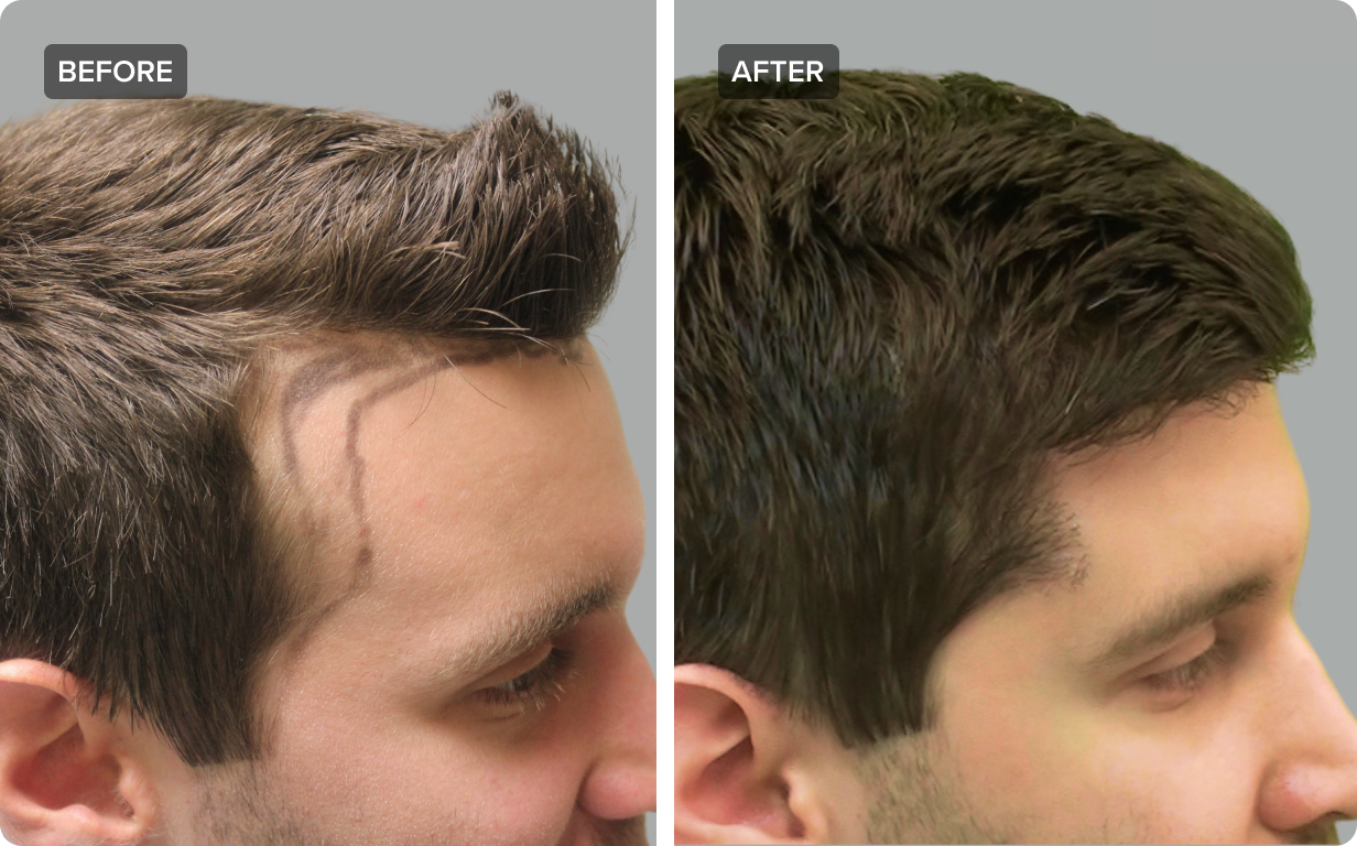 FUE vs. FUT: What Type Of Hair Transplant Is Best For You?