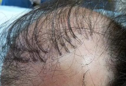 The history of hair transplant surgery