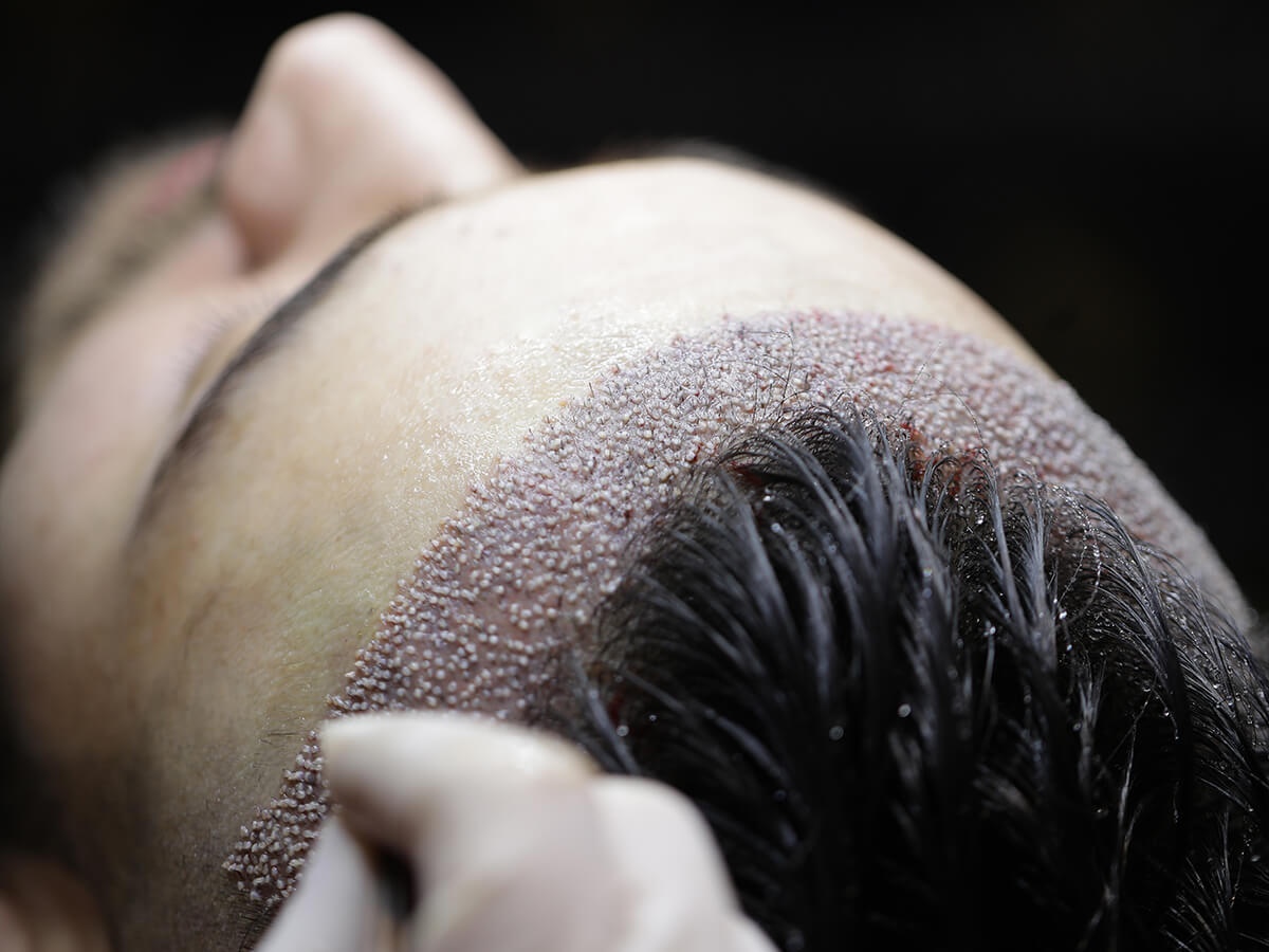 The latest hair transplant technology trends