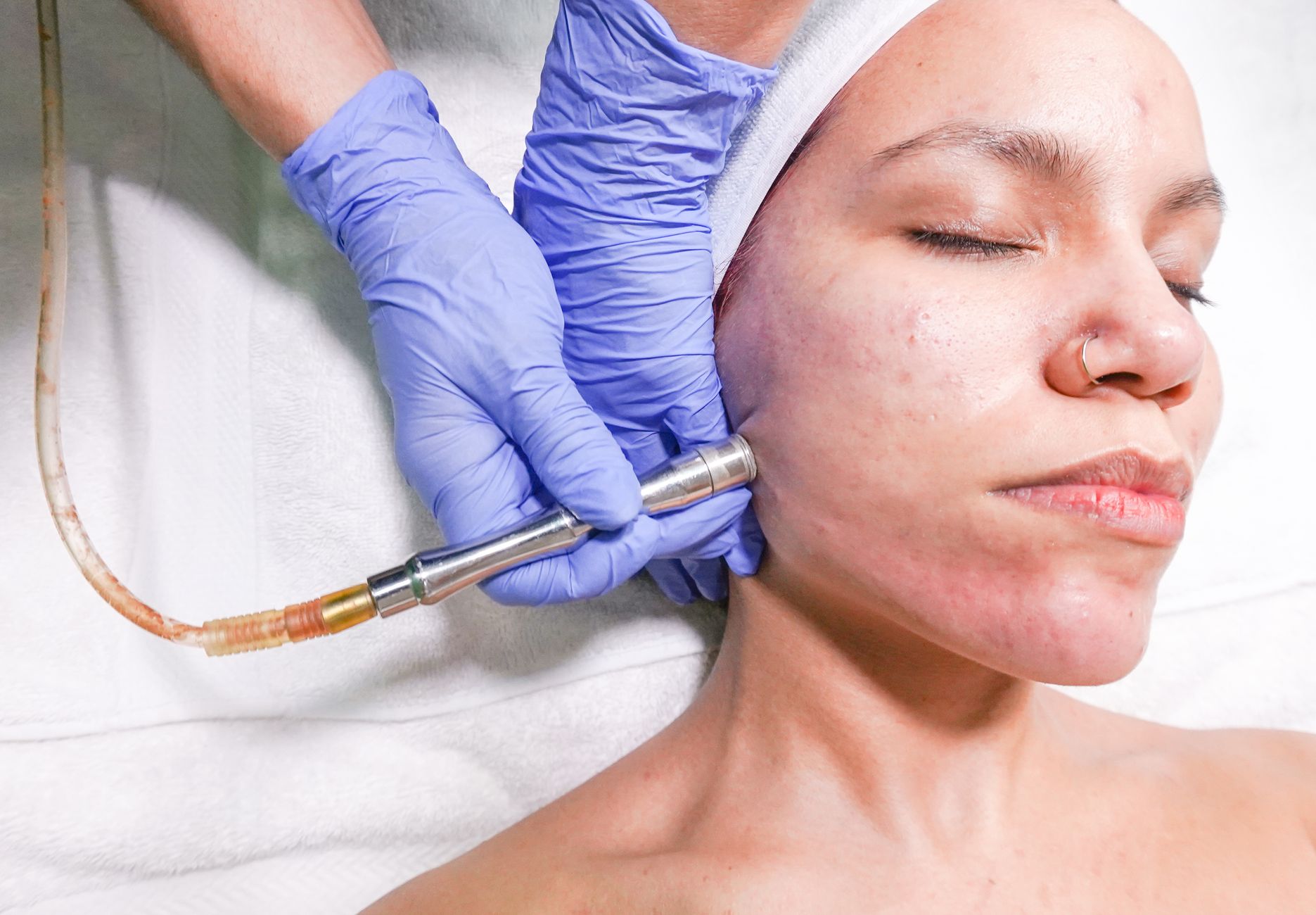 Can Chemical Peels Treat Acne Scars and Sun Damage?