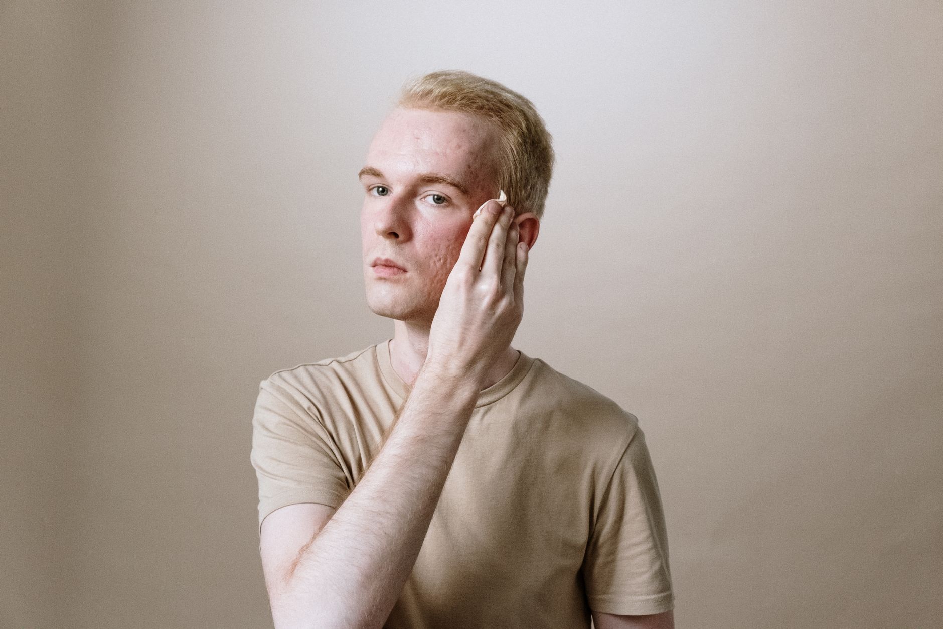 Acne due to your beard, prevent it this way