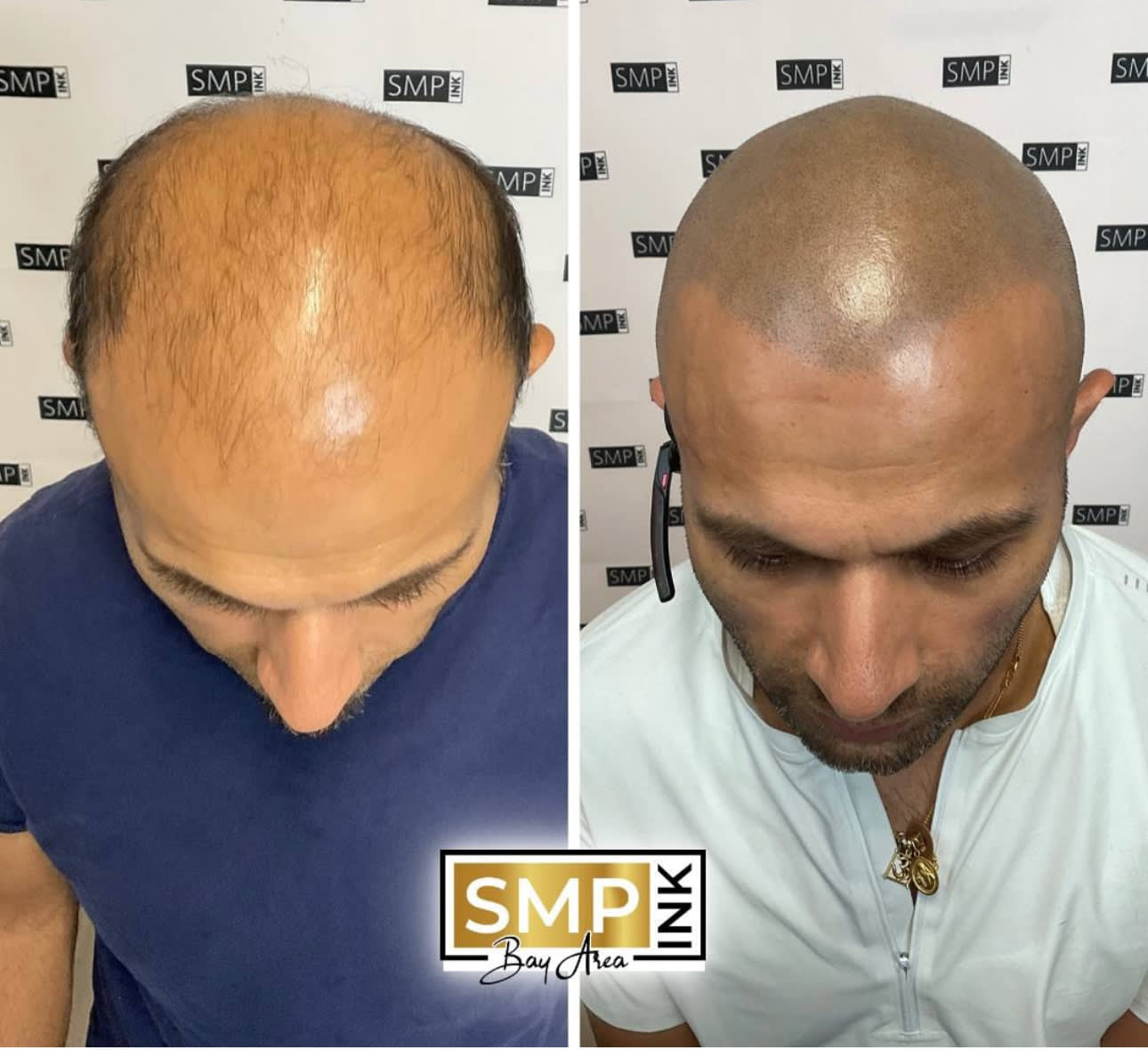 Before and after scalp micropigmentation — SMP Ink SF