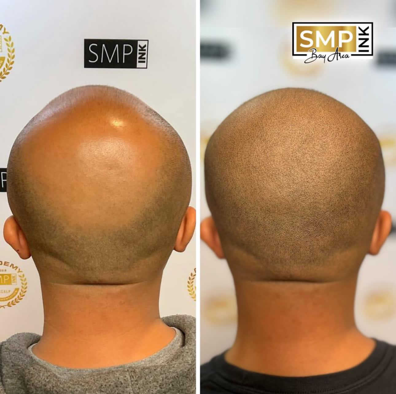 Before and after scalp micropigmentation — SMP Ink SF