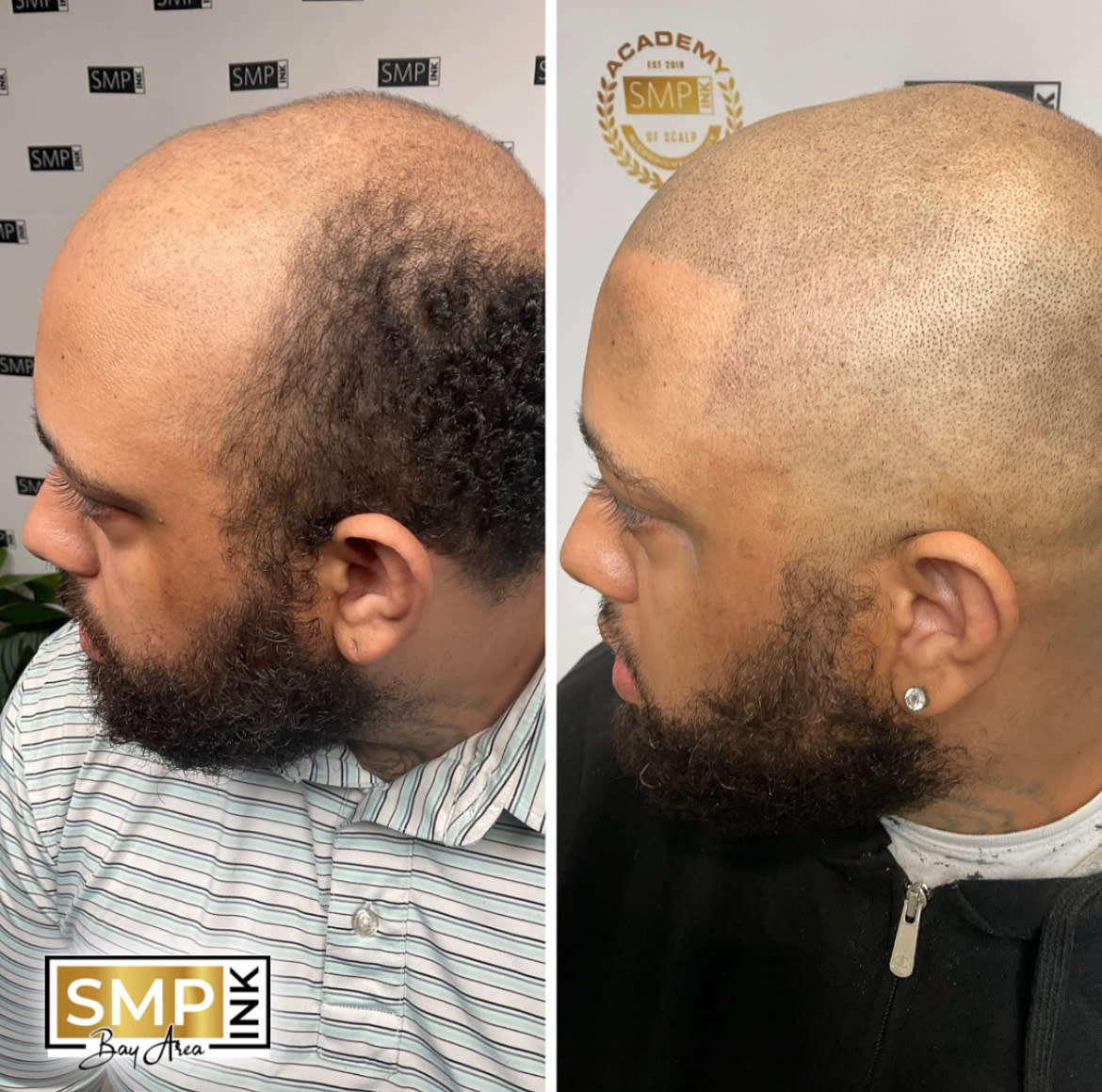 Before and after scalp micropigmentation — SMP Ink SF