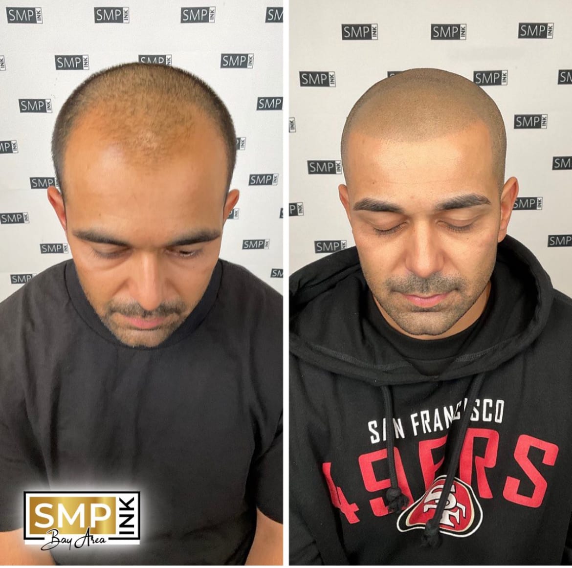 Before and after scalp micropigmentation — SMP Ink SF