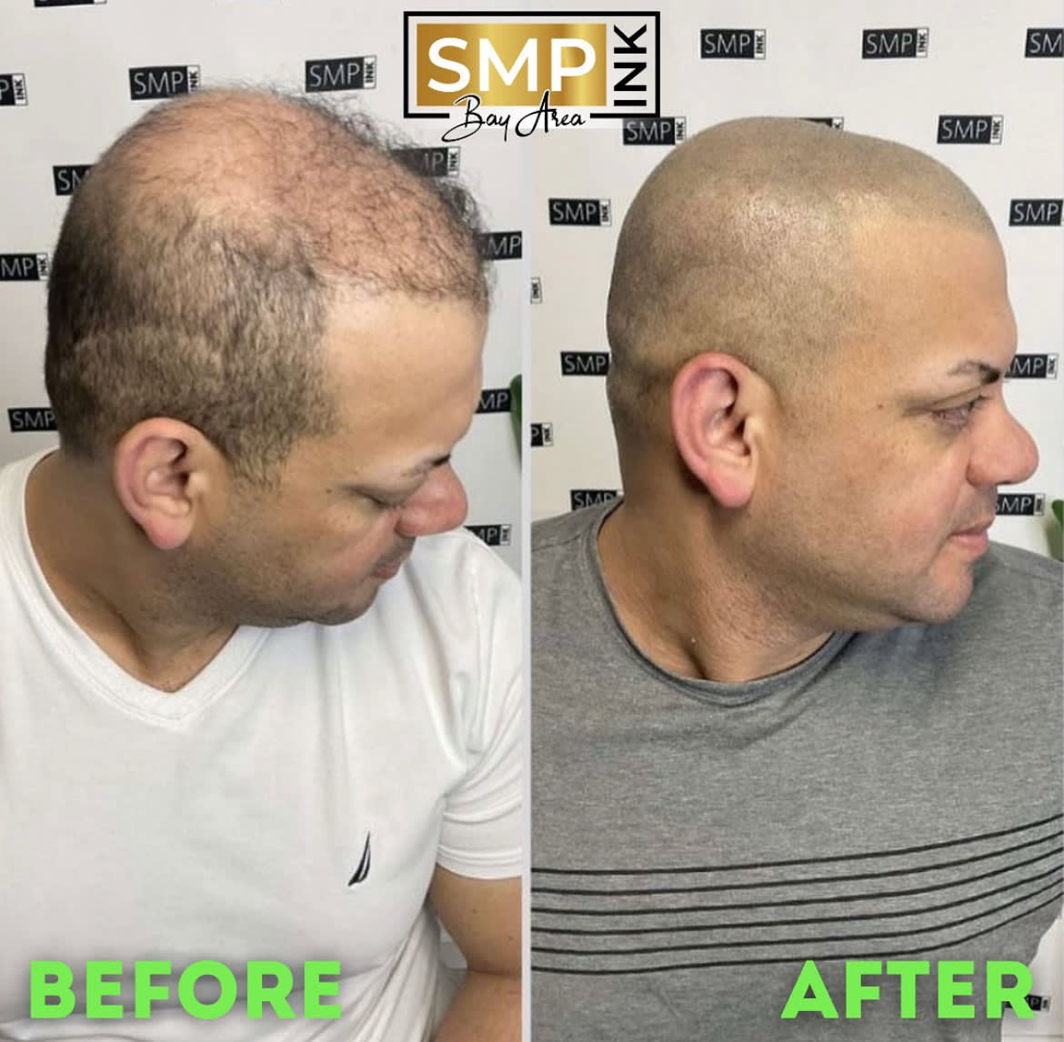 Before and after scalp micropigmentation — SMP Ink SF