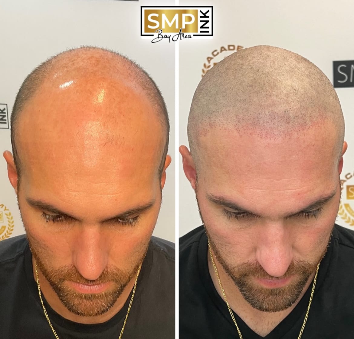 Before and after scalp micropigmentation — SMP Ink SF