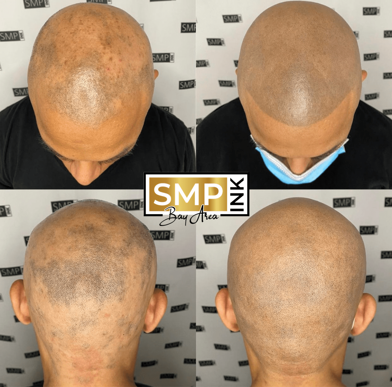 Before and after scalp micropigmentation — SMP Ink SF