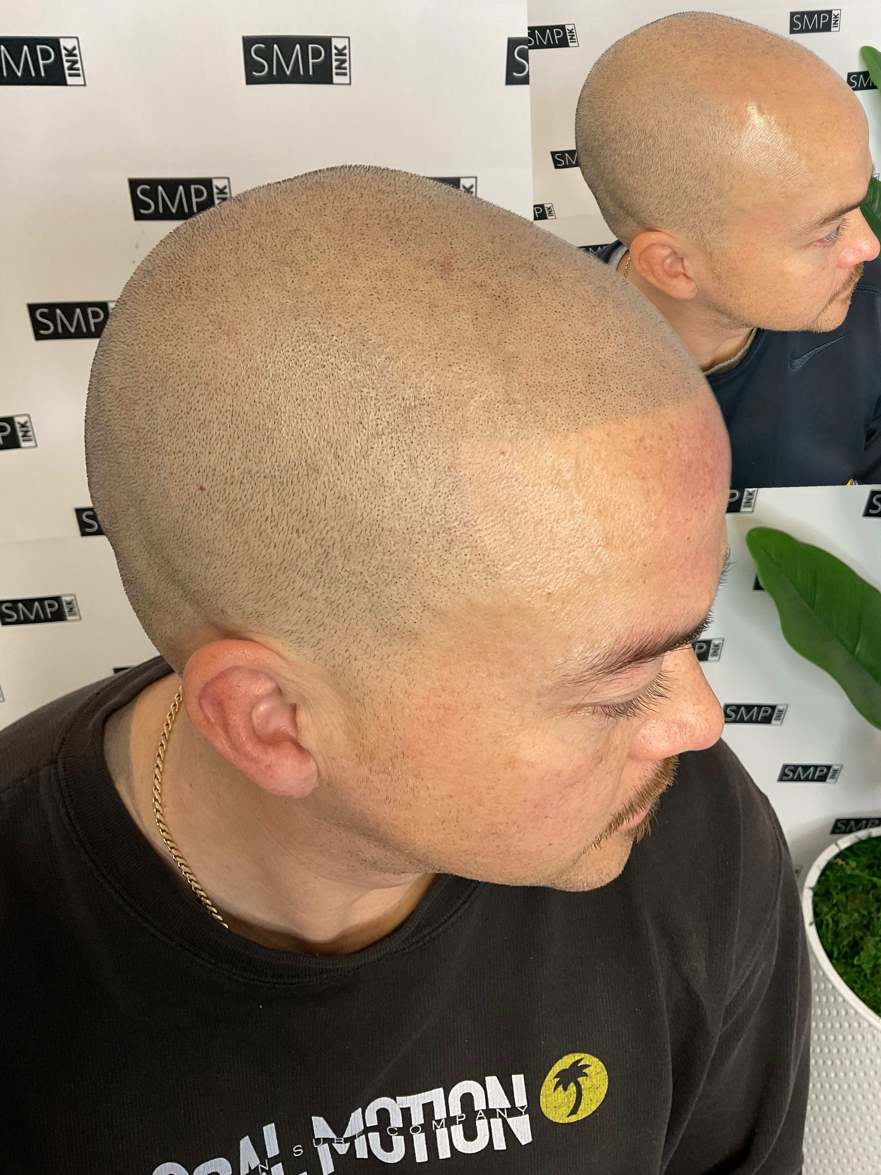 Before and after scalp micropigmentation — SMP Ink SF