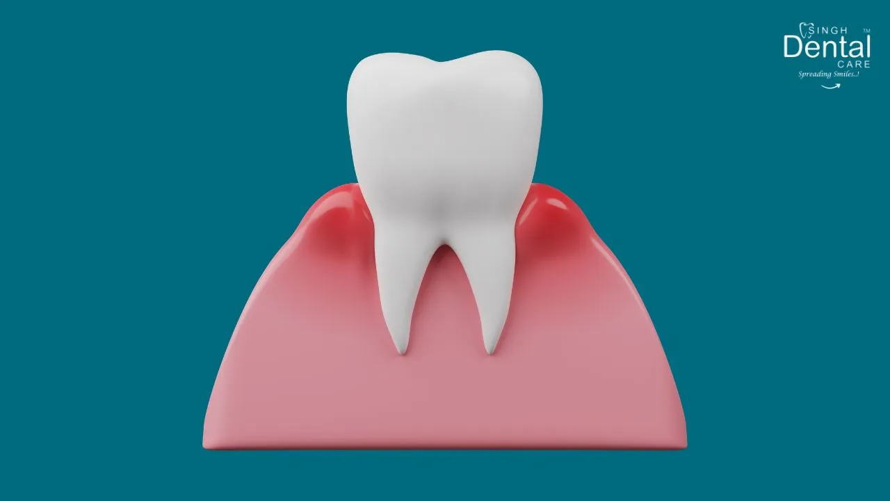 Gingivitis