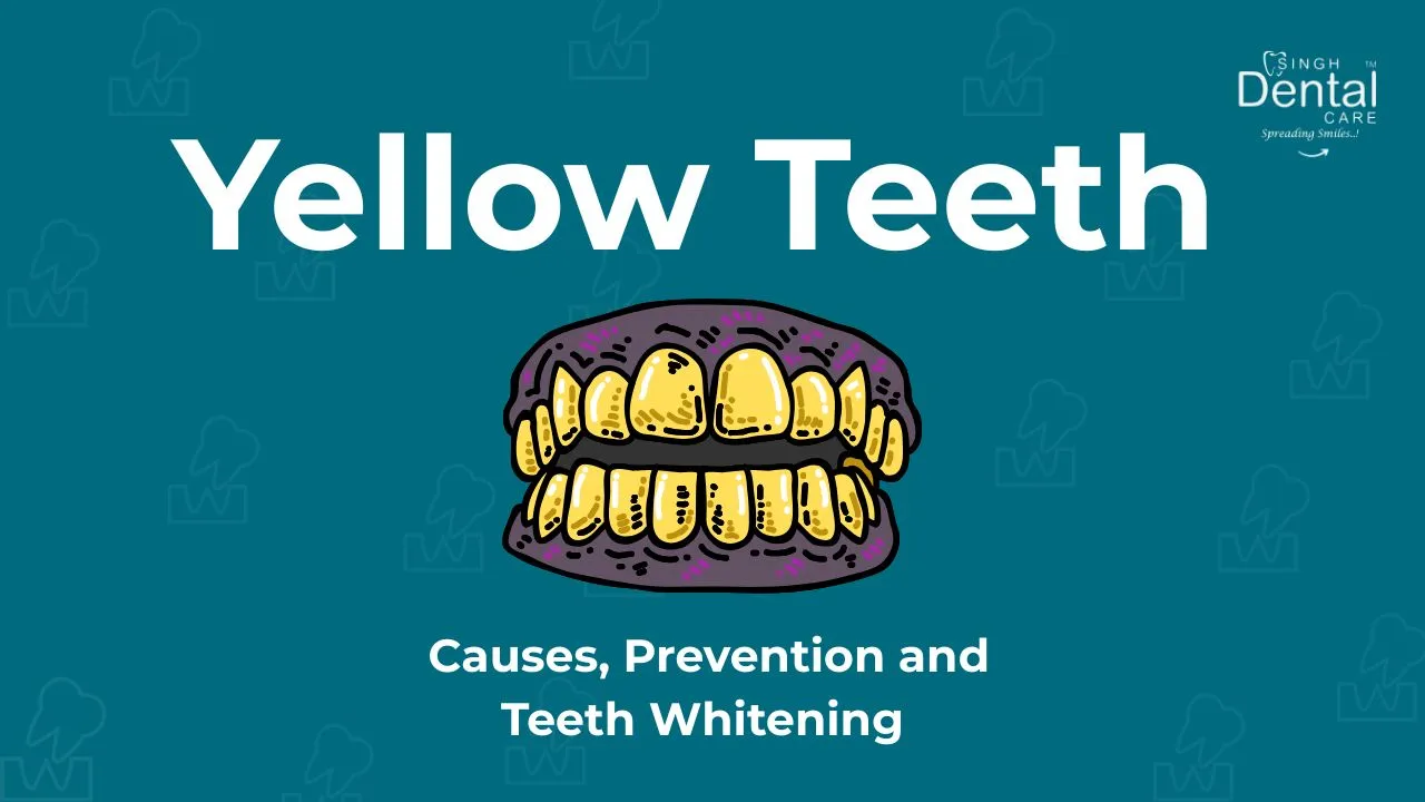 Yellow Teeth: Causes, Prevention & Best Whitening Options | Singh Dental Care
