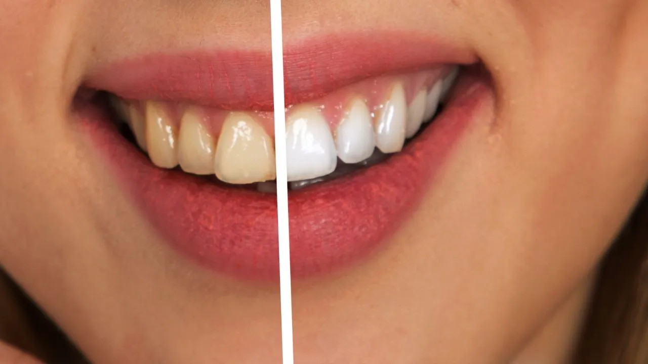 teeth whitening