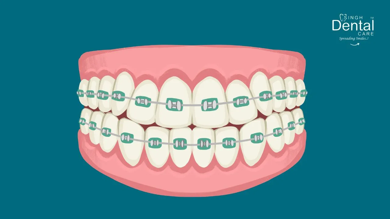 Orthodontic Braces