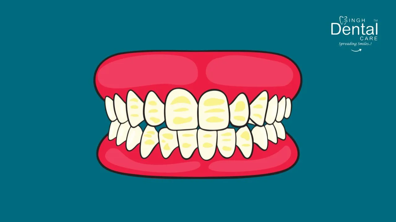 Dental Fluorosis