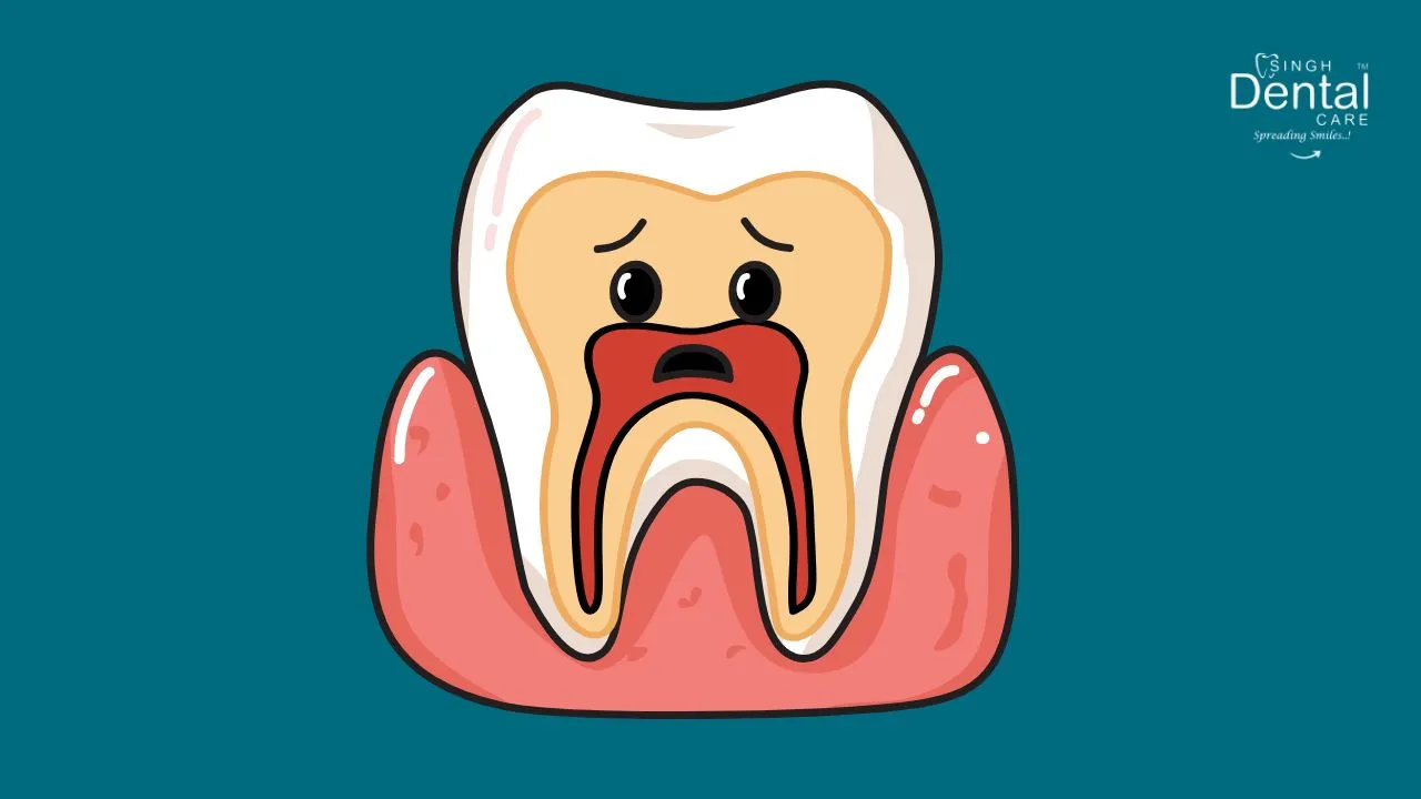 Indirect Pulp Capping
