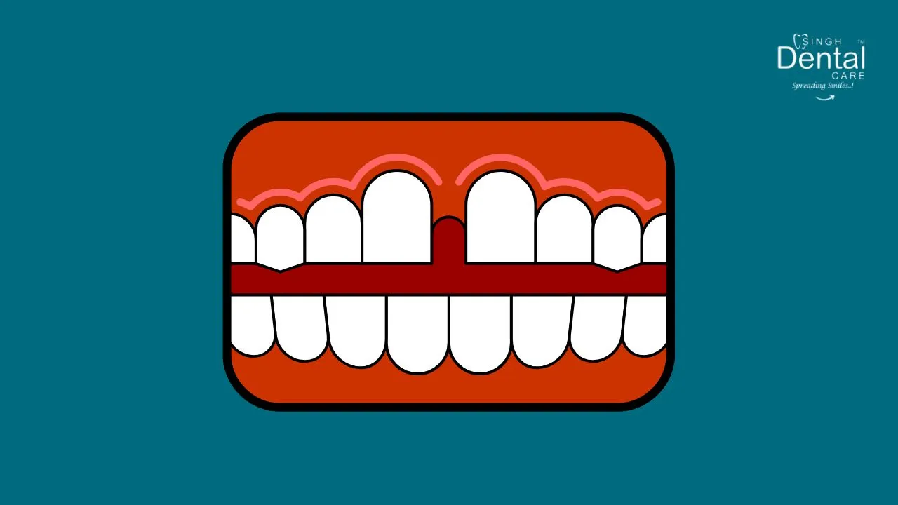 Midline Diastema