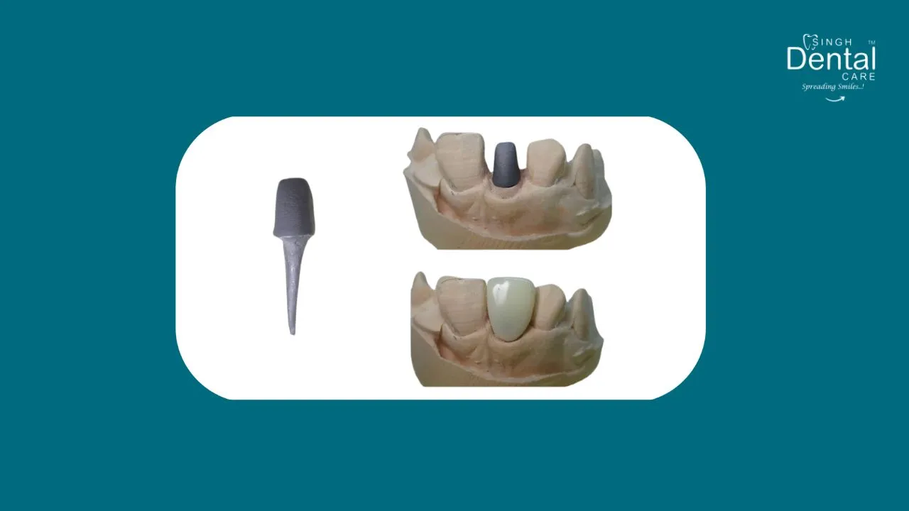 Post and Core