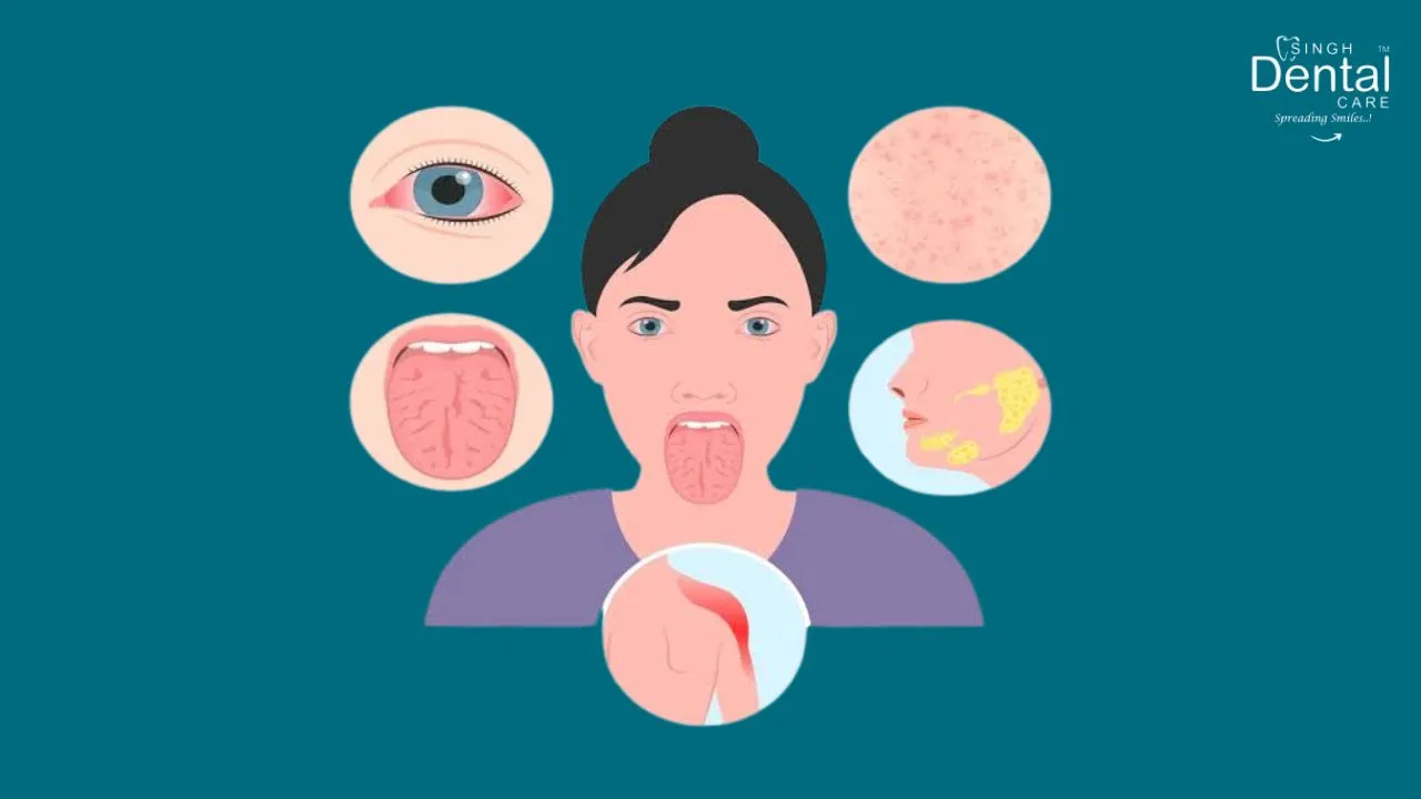 Sjögren's Syndrome