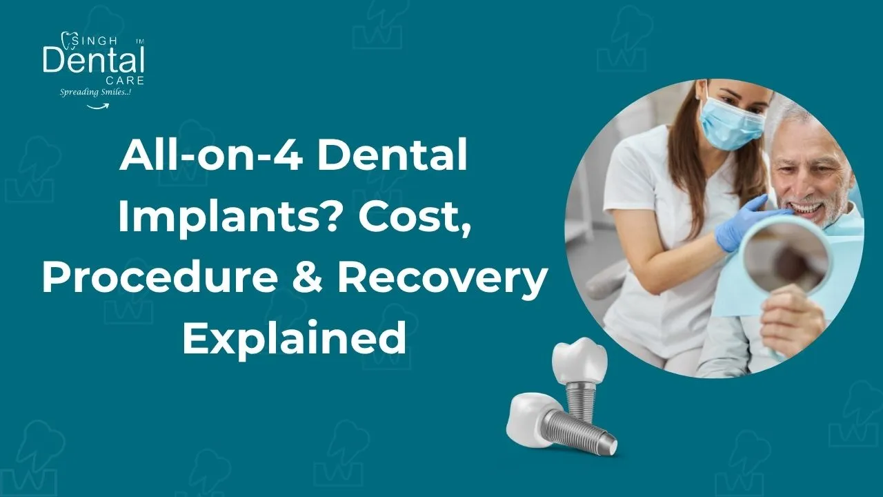 What Are All-on-4 Dental Implants? Cost, Procedure & Recovery Explained