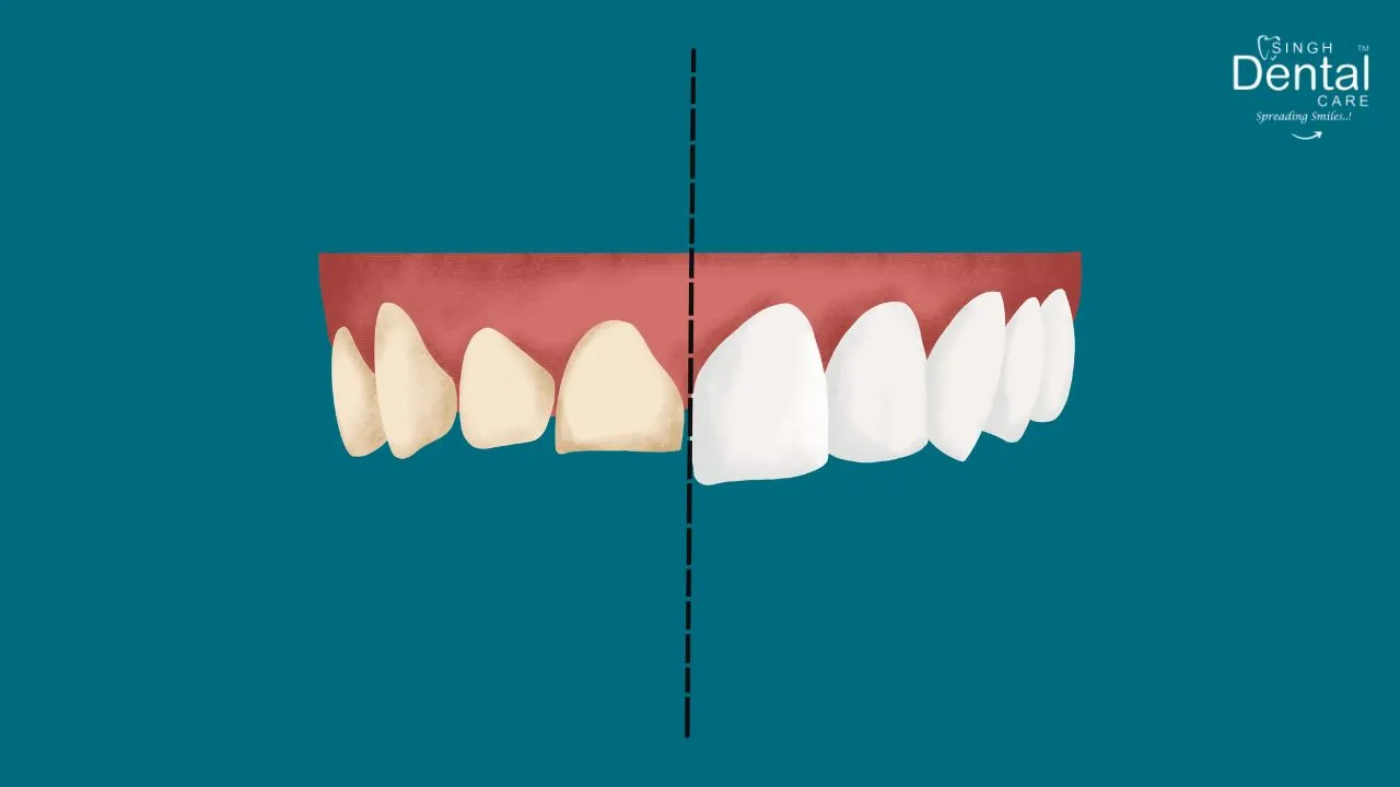 Veneers