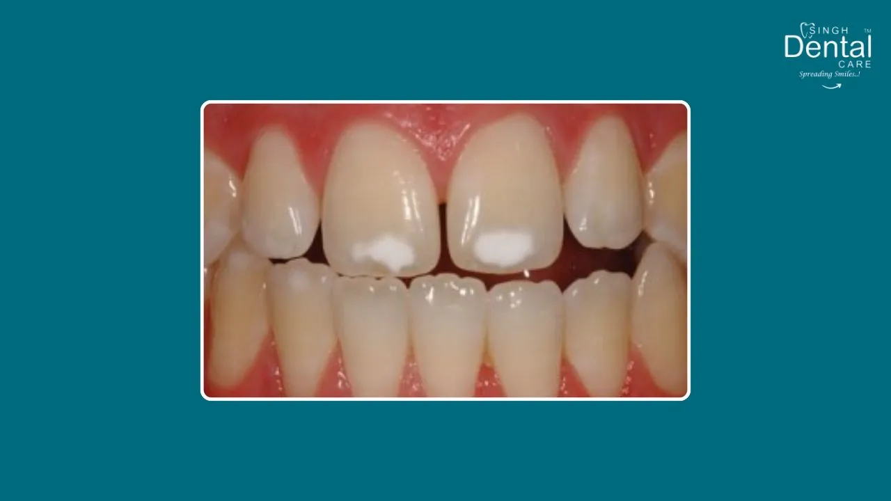 White Spot Lesions