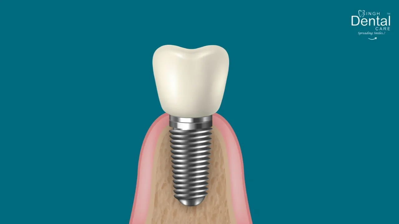 Dental Implants