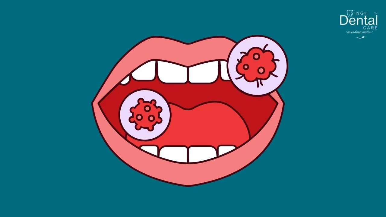 Oral Cancer