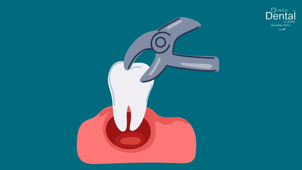 Tooth Extraction